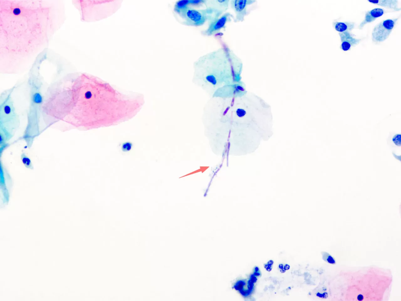 Candida-albicans.jpg Candida-albicans.jpg