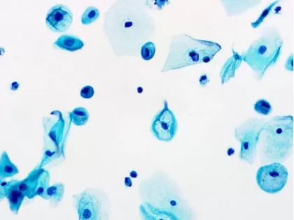 Pseudo-Koilocytes.jpg Pseudo-Koilocytes.jpg