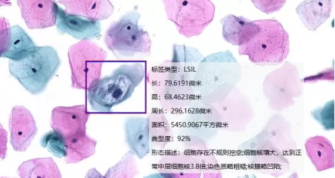 Typical-LSIL-image.jpg Typical-LSIL-image.jpg