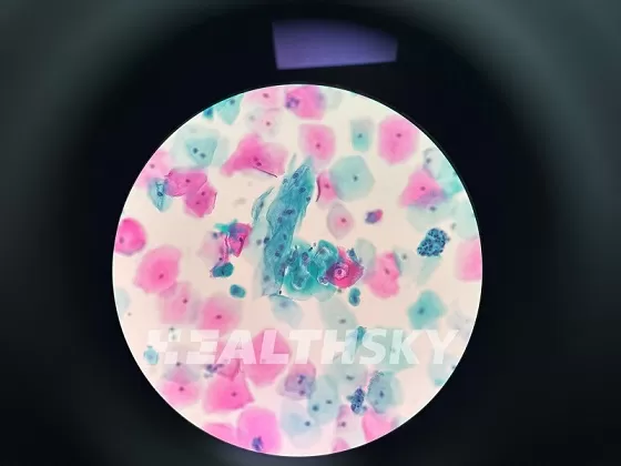 cervical-liquid-based-cytology.jpg cervical-liquid-based-cytology.jpg